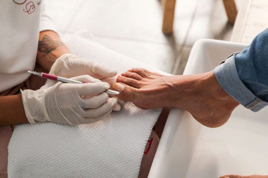 comment soigner un ongle incarné rapidement